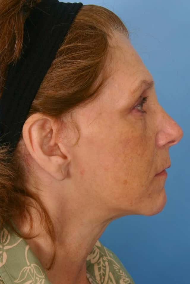 Facelift Before & After Case 41 after