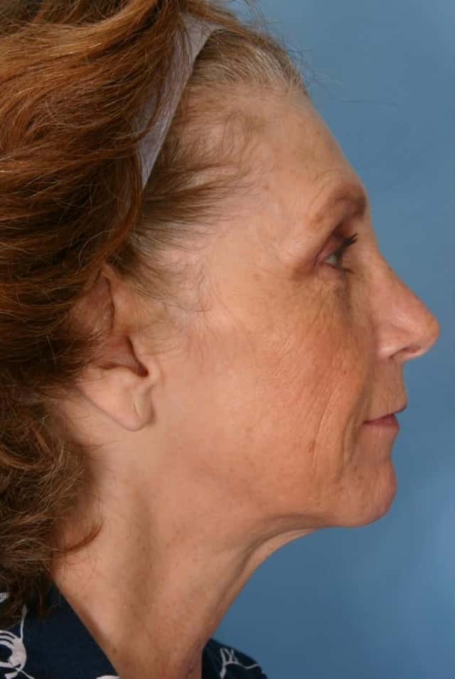Facelift Before & After Case 41 before