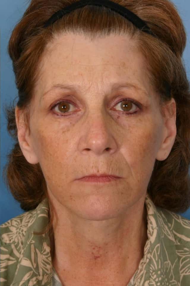 Facelift Before & After Case 41 after
