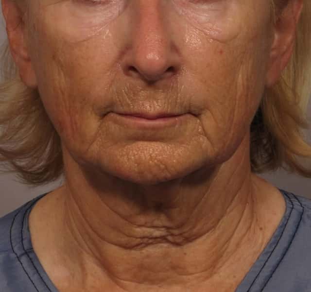 Facelift with Eyelid Lift Frontal View Before and After Photos by Dr. Kent Hasen