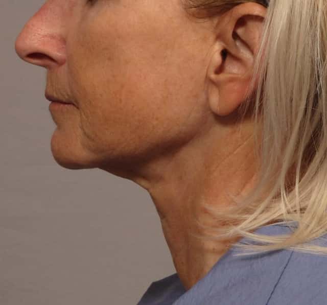 Before and 8 Months After Facelift, Upper Lip Lift and Eyelid Lift by Dr. Kent Hasen, Naples, FL