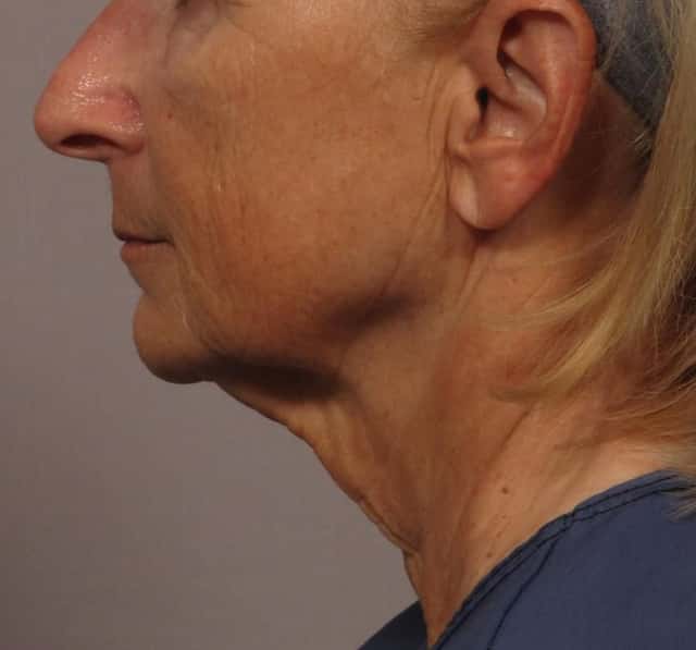 Facelift, Upper Lip Lift and Eyelid Lift Left Side View Before and 8 Months After by Dr. Kent Hasen, Naples, FL