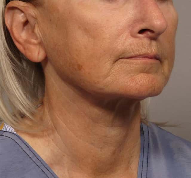 Before and 8 Months After Facelift, Upper Lip Lift and Eyelid Lift Left by Dr. Kent Hasen, Naples, FL