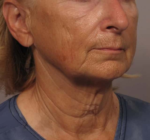 Facelift, Upper Lip Lift and Eyelid Lift Right Oblique View Before and 8 Months After by Dr. Kent Hasen, Naples, FL