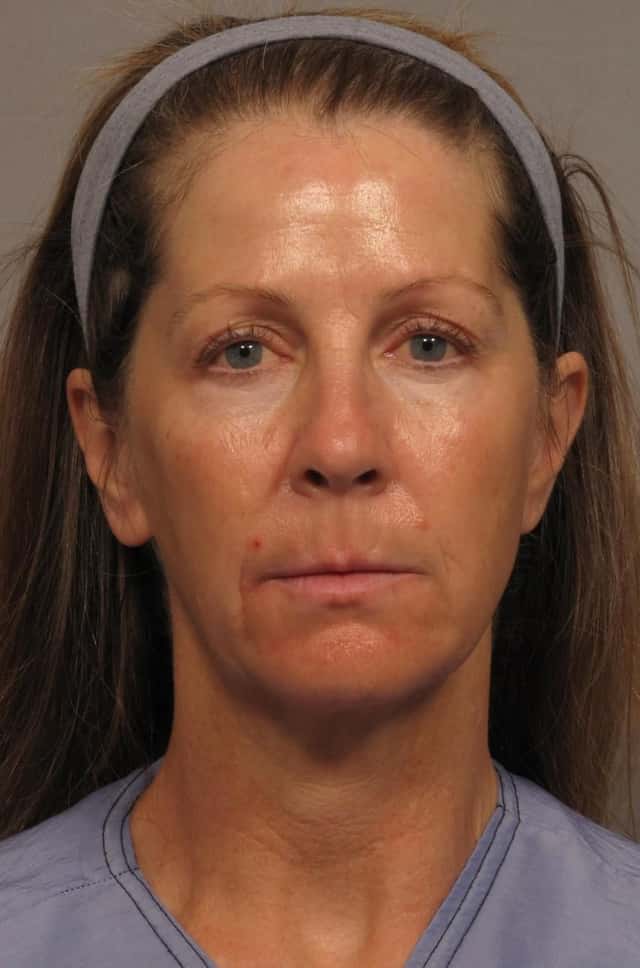 Facelift with Brow Lift, Before and 1 year After Photos, Frontal View, by Dr. Kent Hasen of Naples, Florida