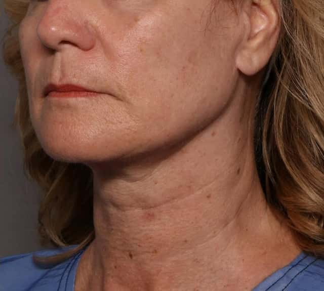 Before and 7 Months After Facelift by Dr. Kent V. Hasen