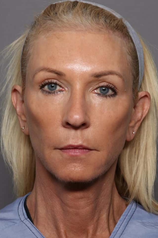 Before and After Photos at 1 year from Facelift, Blepharoplasty, Brow Lift by Dr. Kent Hasen