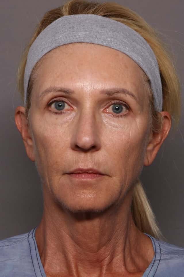 Facelift, Blepharoplasty, and Brow Lift Before and After Photos at 1 year, Frontal View by Dr. Kent Hasen