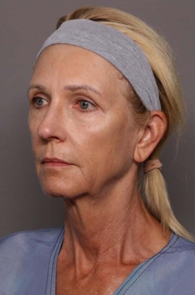 Case #429 - Facelift, Browlift and Blepharoplasty in 60 year old woman by Dr. Kent Hasen before