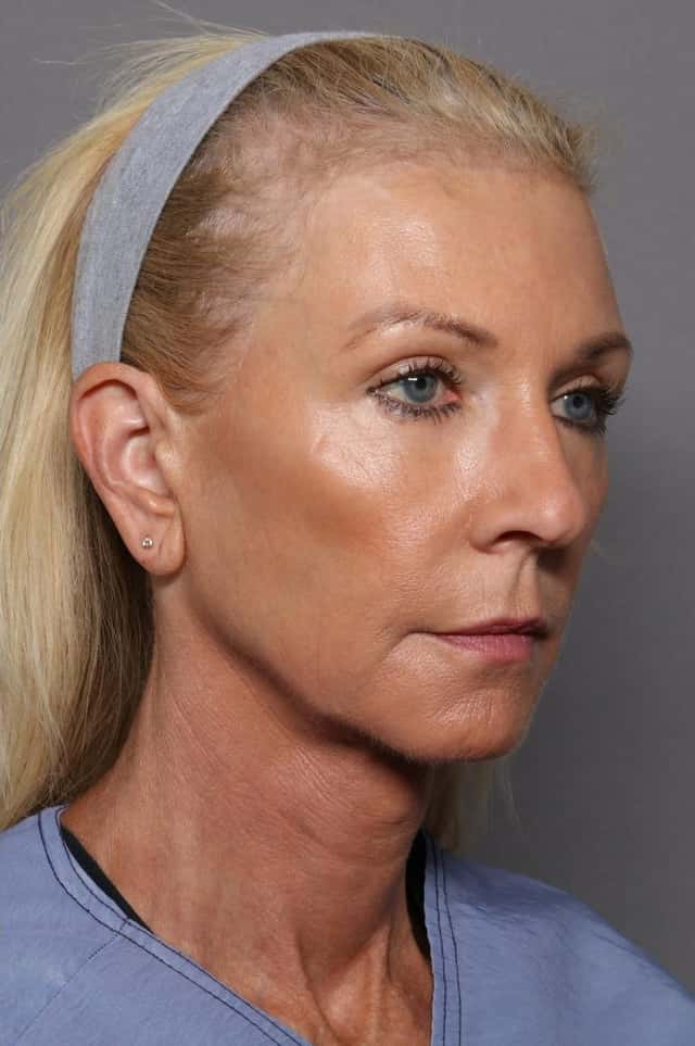 Before and After Facelift, Blepharoplasty, and Brow Lift at 1 year by Dr. Kent Hasen