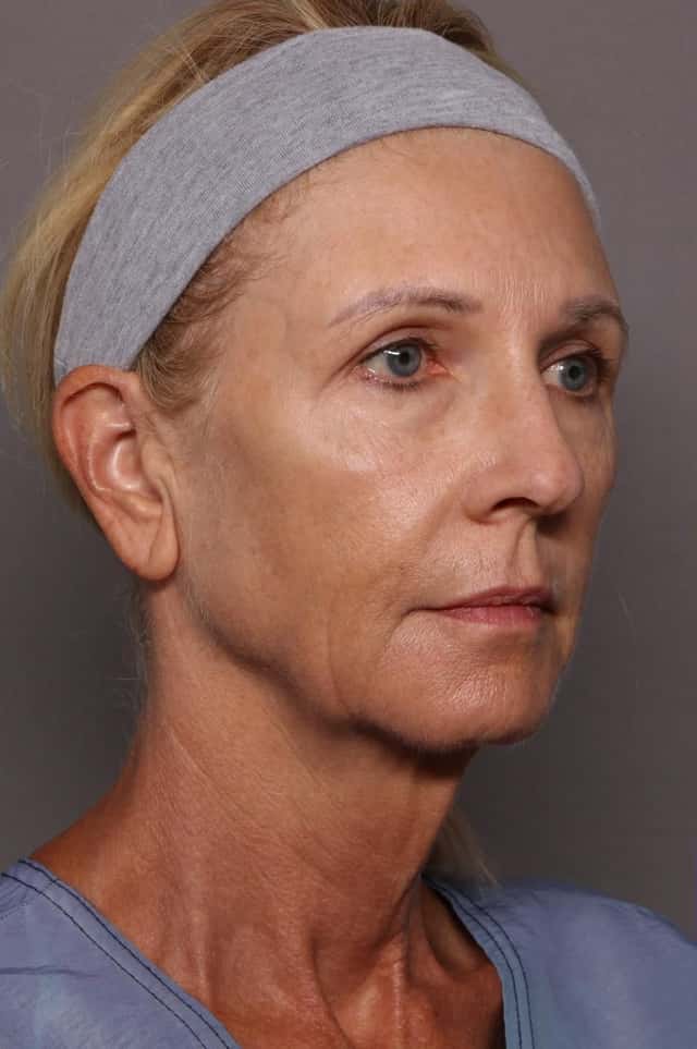 Facelift, Blepharoplasty, and Brow Lift Before and After Photos at 1 year, Right Oblique View by Dr. Kent Hasen