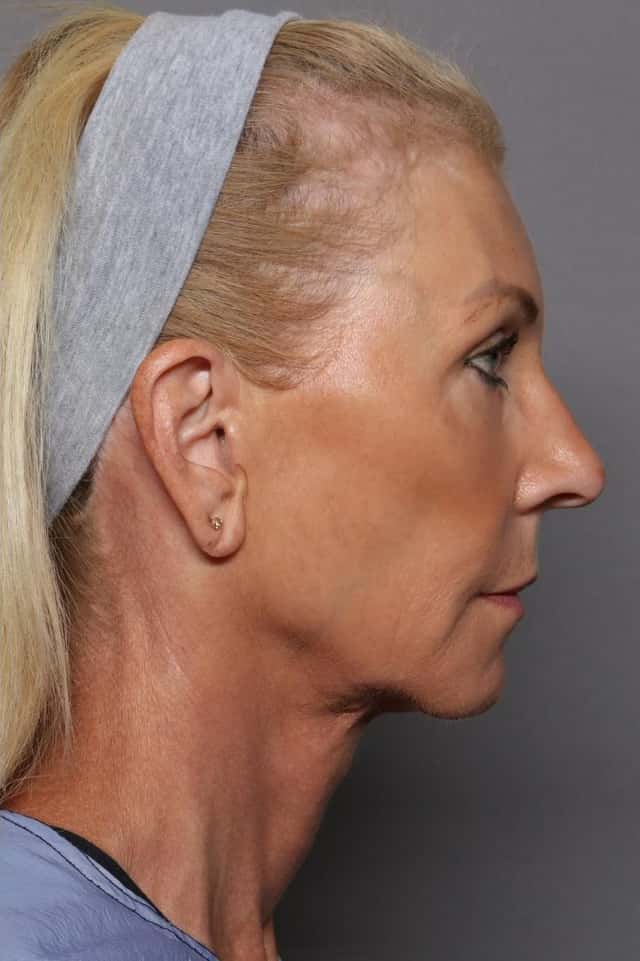Before and After at 1 year from Facelift, Blepharoplasty, and Brow Lift by Dr. Kent Hasen