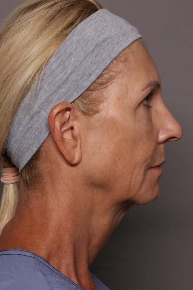 Facelift, Blepharoplasty, and Brow Lift Before and After Photos at 1 year, Rigth Side View by Dr. Kent Hasen