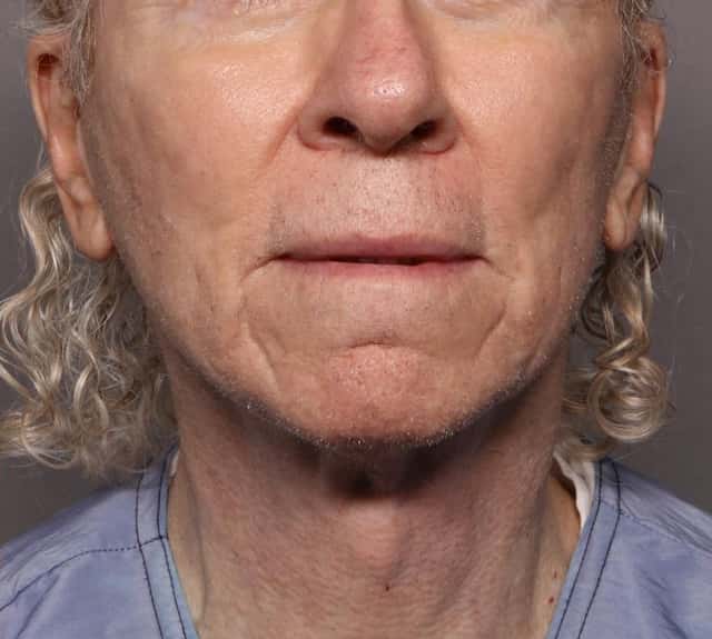 Before and After Facelift at 3 Months by Dr. Kent V. Hasen