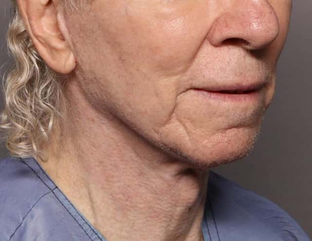 Before and After Facelift at 3 Months by Dr. Kent V. Hasen