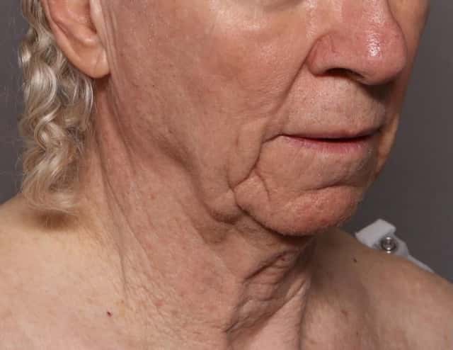 Facelift, Before and After at 3 Months, Right Oblique View, by Dr. Kent V. Hasen