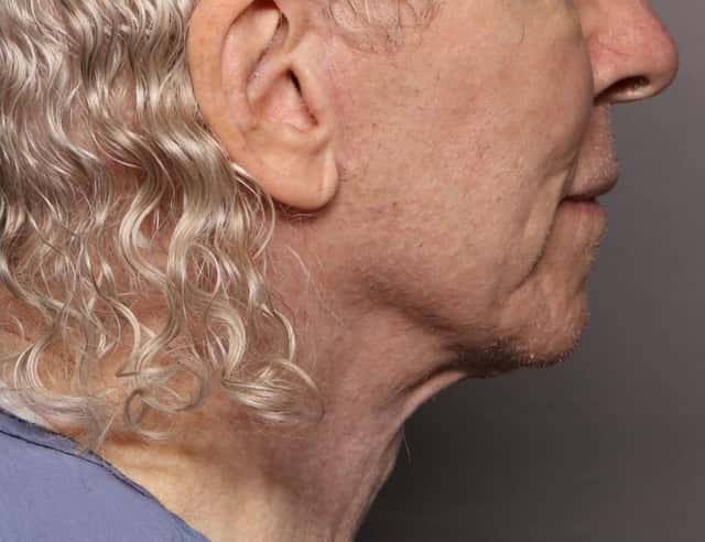 Before and After Facelift at 3 Months by Dr. Kent V. Hasen