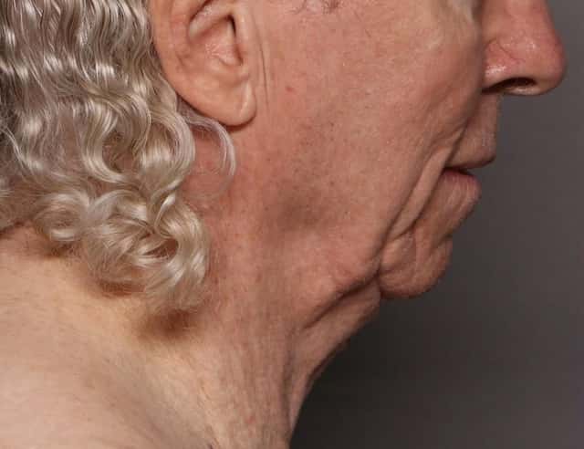 Facelift, Before and After at 3 Months, Right Side View, by Dr. Kent V. Hasen