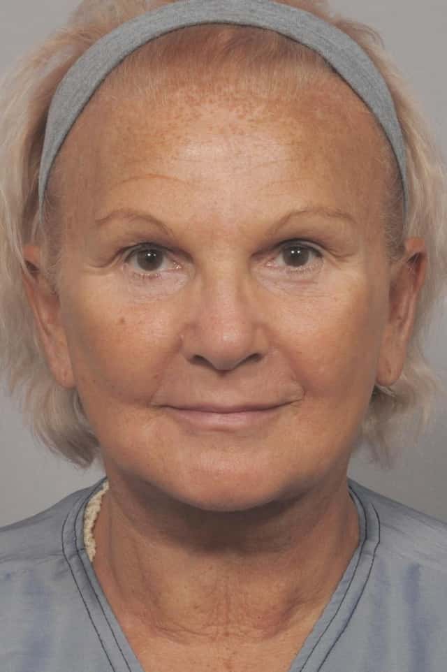 Facelift, Browlift and Fat Grafting, Before and After Photos by Dr. Kent Hasen