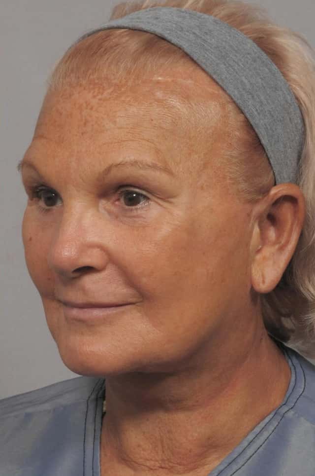 Facelift, Browlift and Fat Grafting, Before and After, 1 Year Post Op by Dr. Kent Hasen