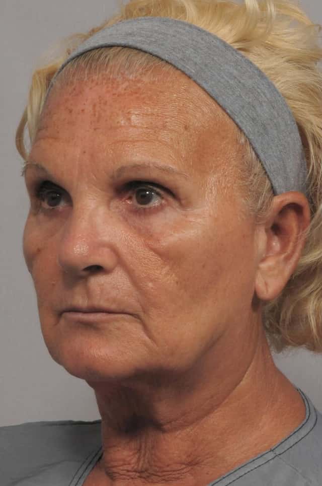 Facelift, Browlift and Fat Grafting, Before and After Photos, 1 Year Post Op, Left Oblique View by Dr. Kent Hasen
