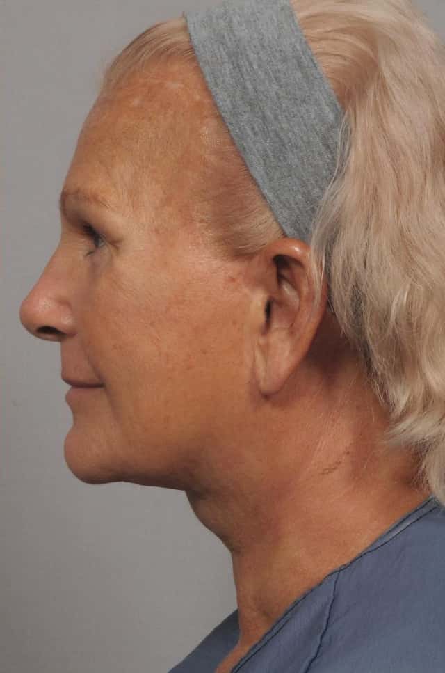 Facelift, Browlift and Fat Grafting, Before and After, 1 Year Post Op by Dr. Kent Hasen
