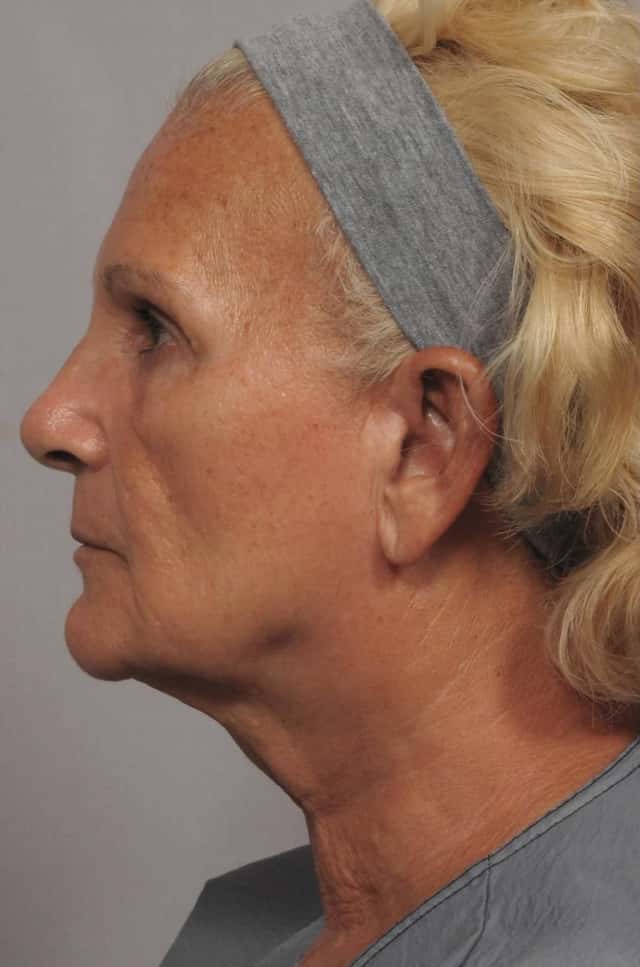 Facelift, Browlift and Fat Grafting, Before and After Photos, 1 Year Post Op, Left Side View by Dr. Kent Hasen