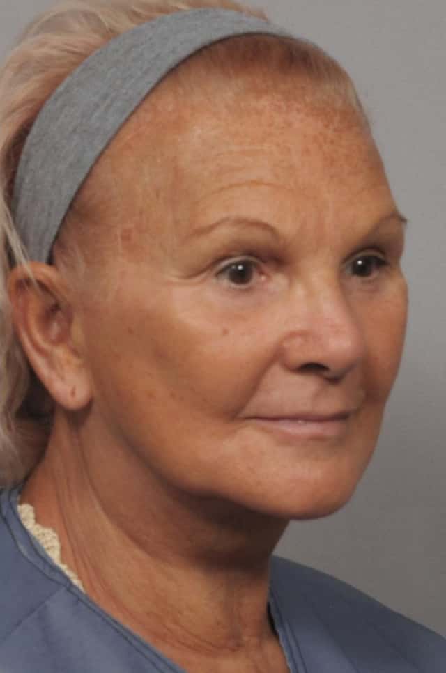 Facelift, Browlift and Fat Grafting, Before and After Photos, 1 Year Post Op by Dr. Kent Hasen