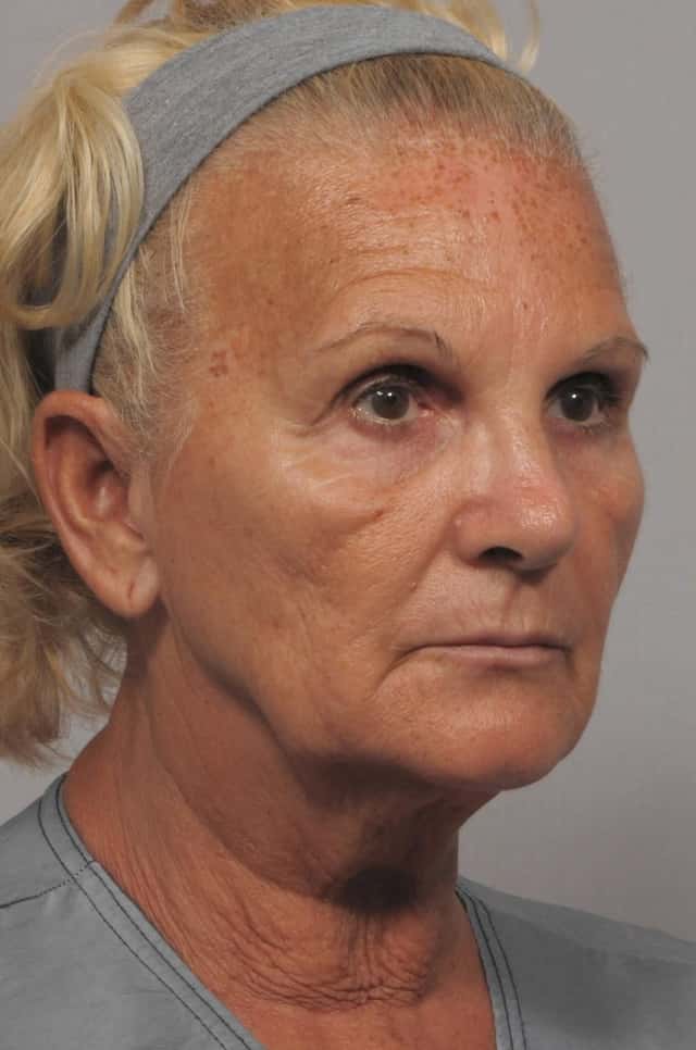 Facelift, Browlift and Fat Grafting, Before and After Photos, 1 Year Post Op, Right Oblique View by Dr. Kent Hasen