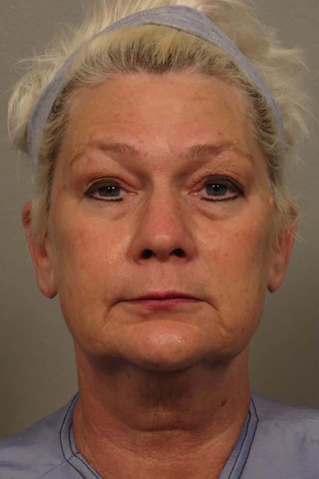 Frontal View of Total Facial Rejuvenation with Facelift, Brow and Eyelid lift, Before and After at 3 months, by Dr. Hasen