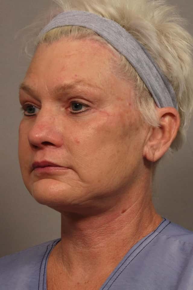 Total Facial Rejuvenation with Facelift, Brow, and Eyelid lift, Before and After at 3 months, by Dr. Hasen