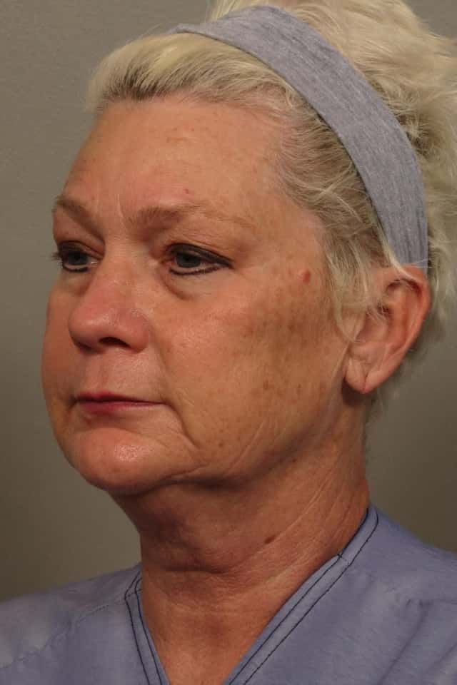 Left Oblique View of Total Facial Rejuvenation with Facelift, Brow and Eyelid lift, Before and After at 3 months, by Dr. Hasen