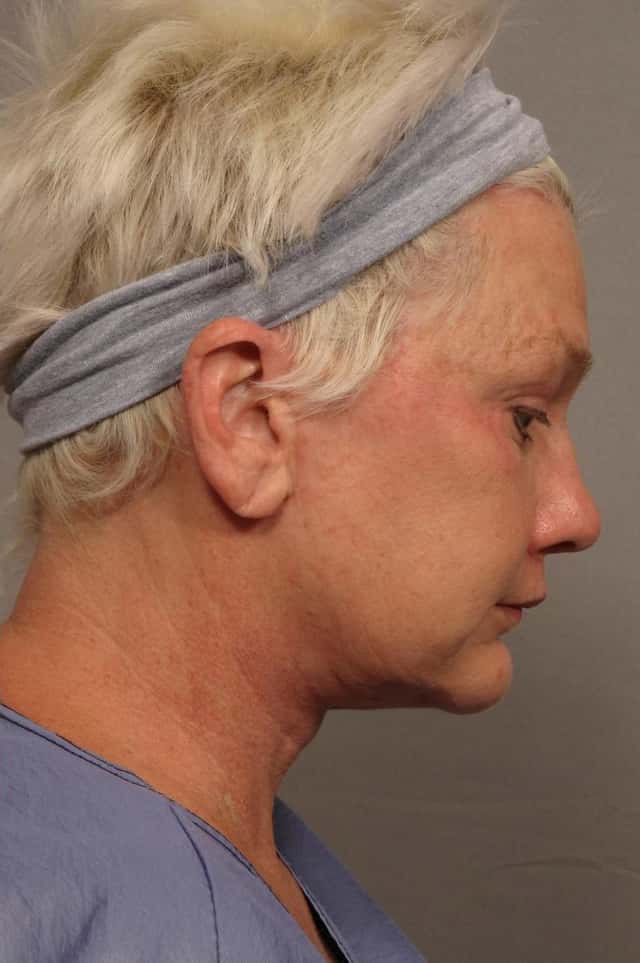 Frontal View of Total Facial Rejuvenation with Facelift, Brow and Eyelid lift, Before and After at 3 months, by Dr. Hasen
