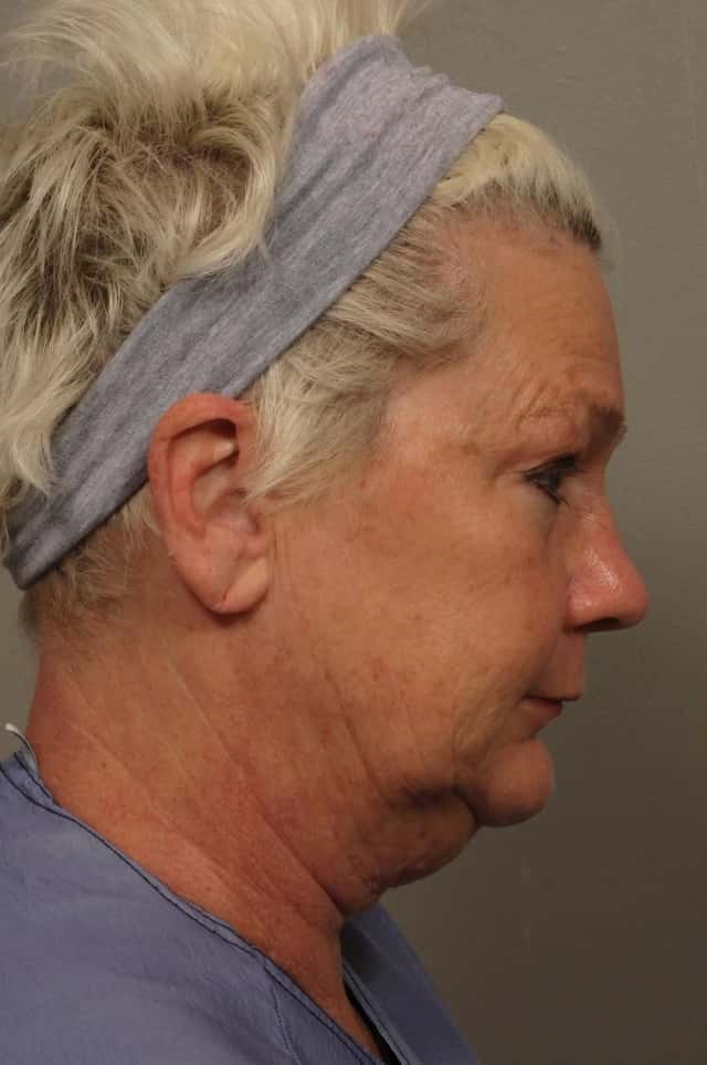 Right Side View of Total Facial Rejuvenation with Facelift, Brow and Eyelid lift, Before and After at 3 months, by Dr. Hasen