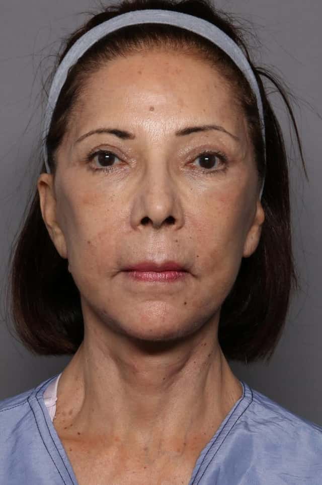Before and After at 3 months from Facelift and Upper Eyelid Lift by Kent V. Hasen, MD
