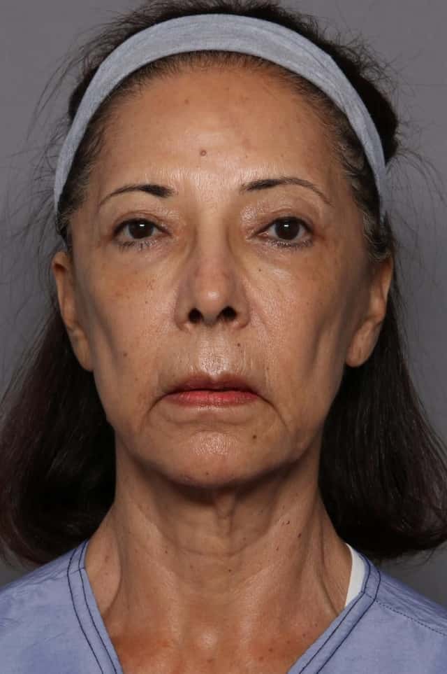 Facelift and Upper Eyelid Lift, Frontal View, Before and After at 3 Months by Kent V. Hasen, MD