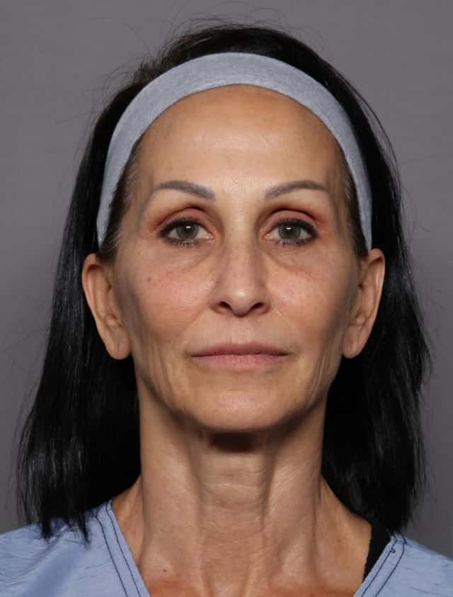 Facelift Before & After Case 439 before