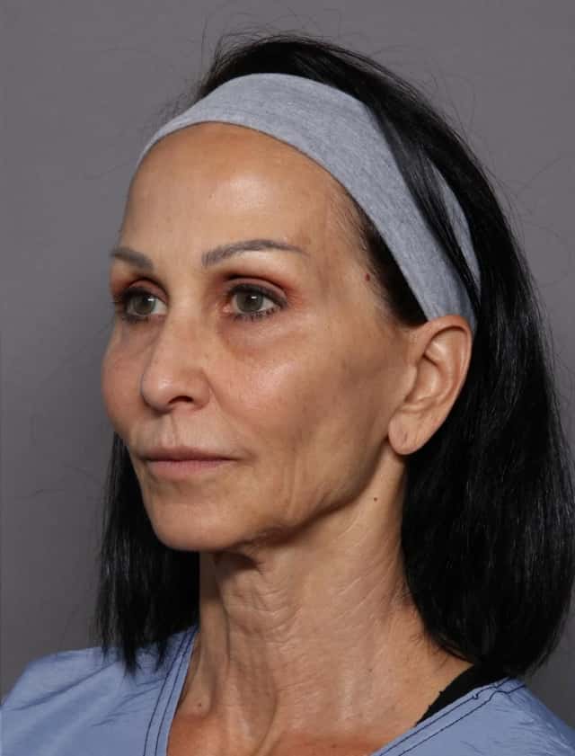 Facelift Before & After Case 439 before