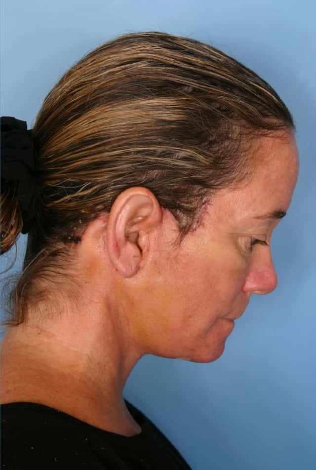 Facelift Before & After Case 66 after