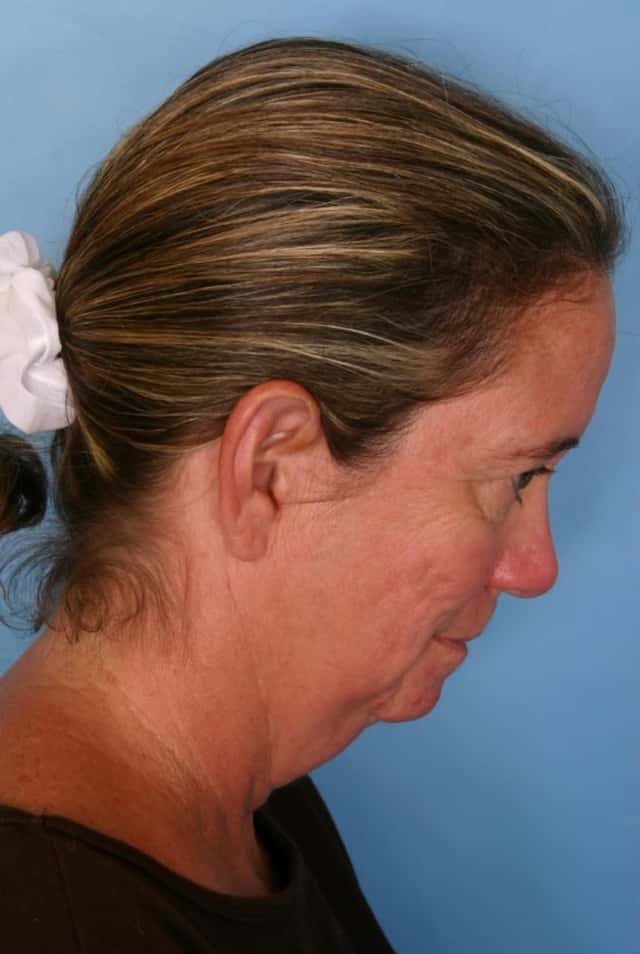 Facelift Before & After Case 66 before