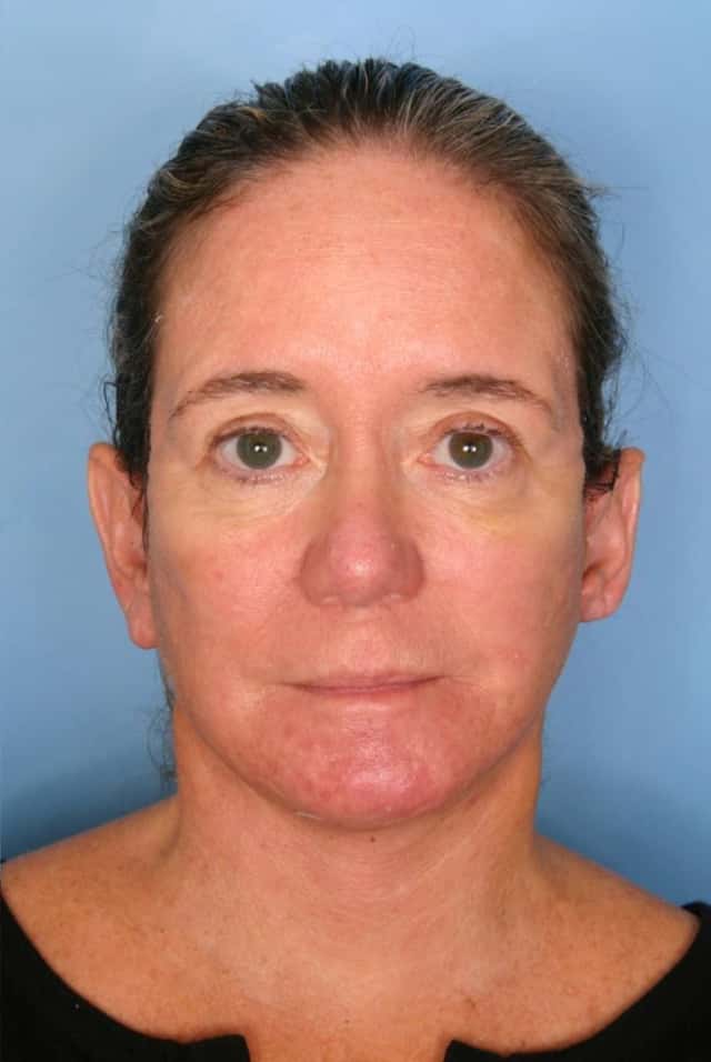 Facelift Before & After Case 66 after