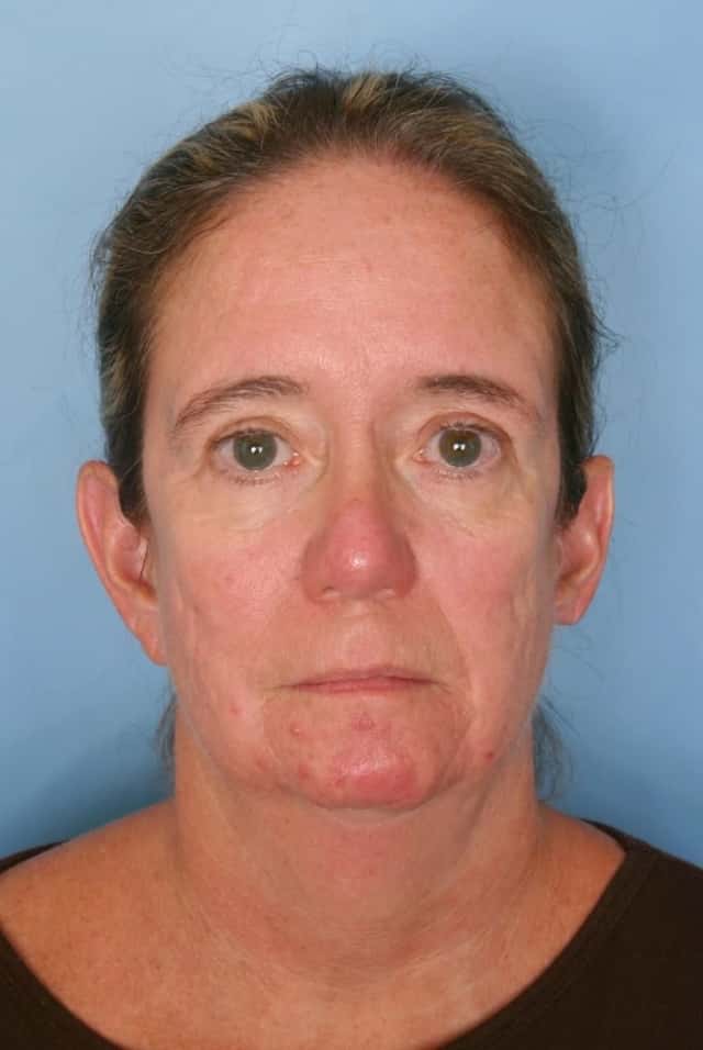 Facelift Before & After Case 66 before