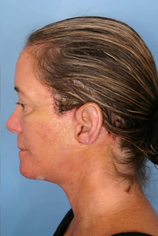 Facelift Before & After Case 66 after