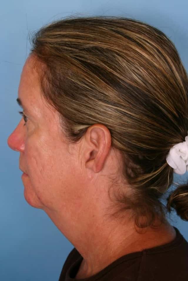 Facelift Before & After Case 66 before