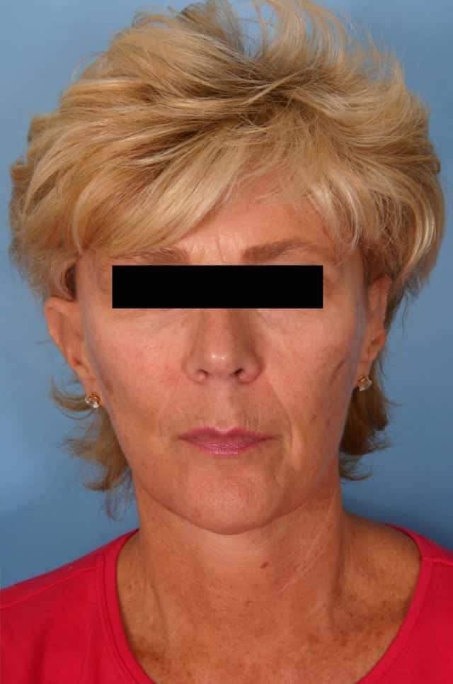 Facelift Before & After Case 8 after