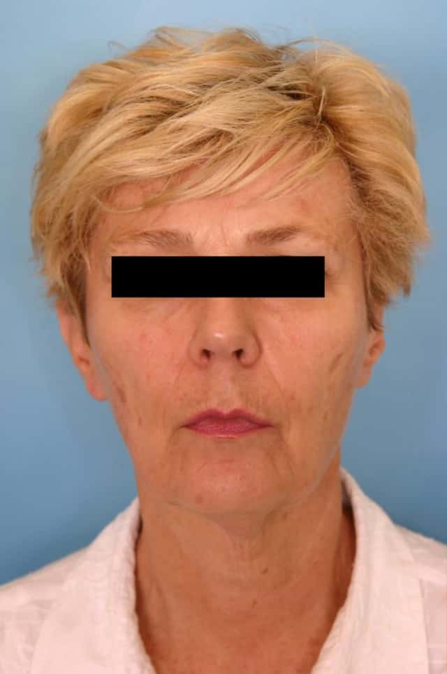 Facelift Before & After Case 8 before
