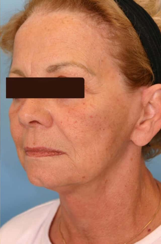 Facelift Before & After Case 9 after