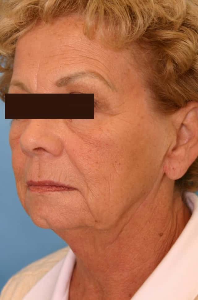 Facelift Before & After Case 9 before