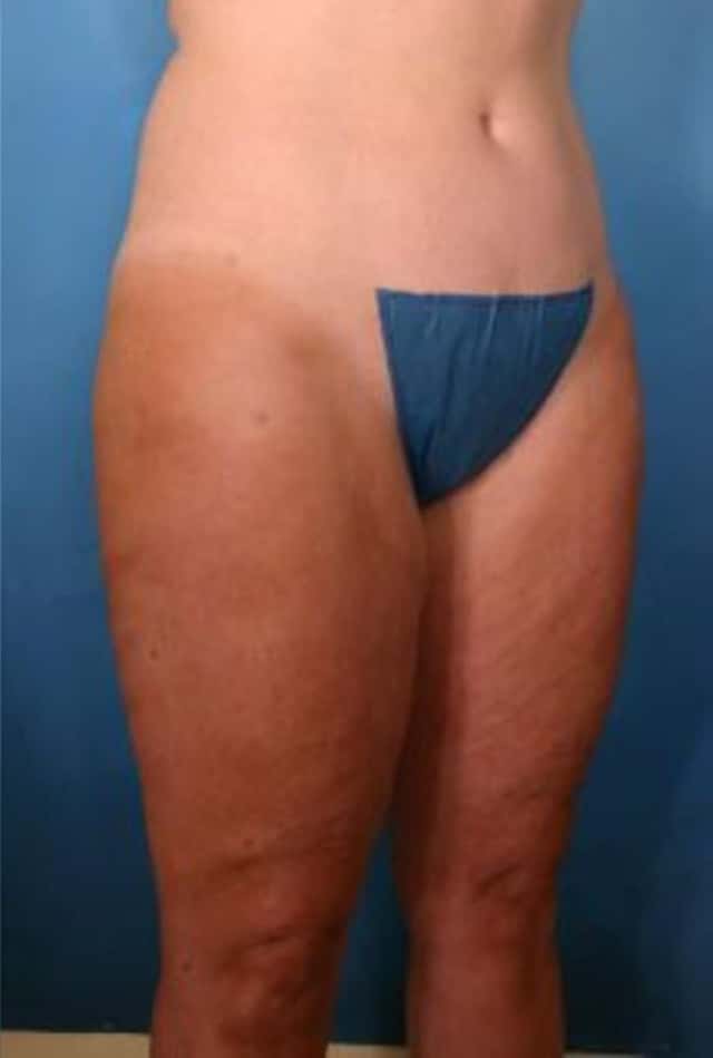 Liposuction Before & After Case 11 after