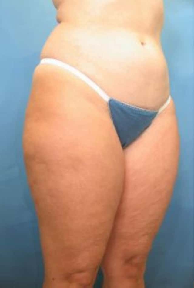 Liposuction Before & After Case 11 before